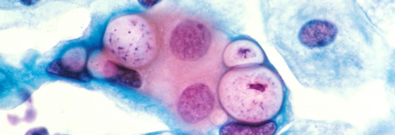 Pap Smear Showing Clamydia In The Vacuoles 500X He E1408949426275 مجلة نقطة العلمية