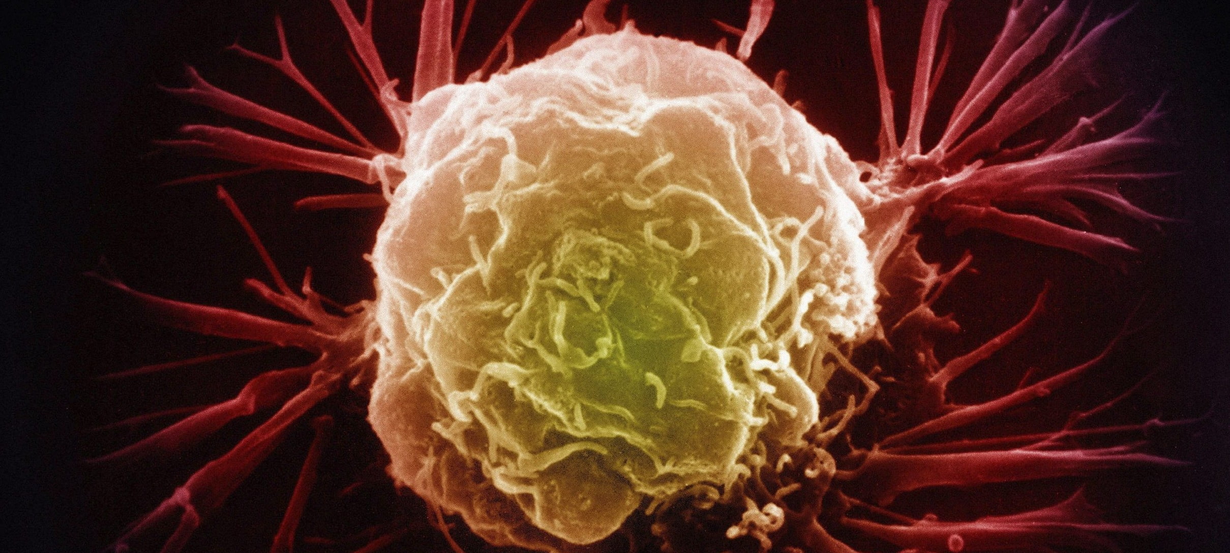 Breast Cancer Cell 014 E1460105913764 مجلة نقطة العلمية