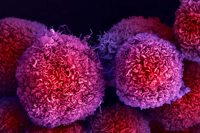c0487293 pancreatic cancer cells sem web بسبب السمنة.. ازدياد مؤشر كتلة الجسم (BMI) يزيد من خطرالإصابة بالسرطان مجلة نقطة العلمية