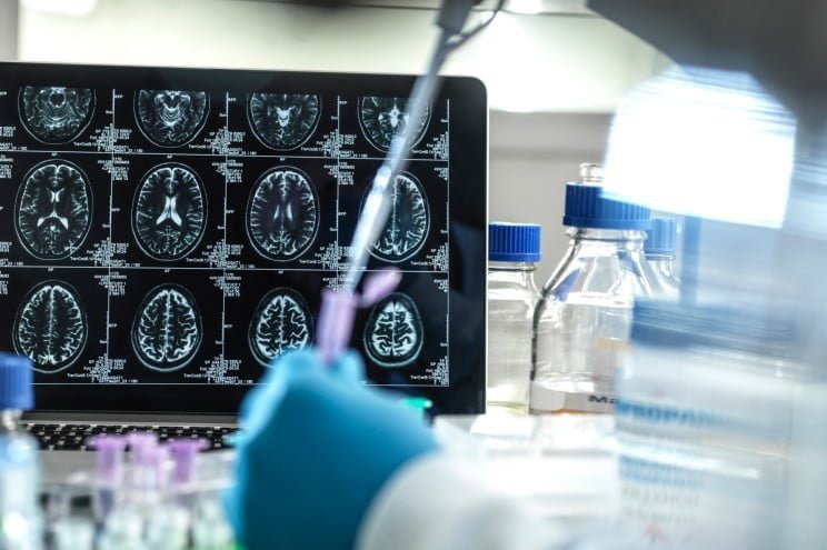 Alzheimer Brain Scan 2 مجلة نقطة العلمية