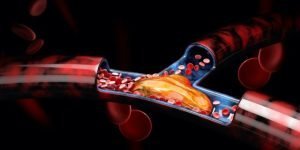 Deep Vein Thrombosis Blood Clots Embolism مجلة نقطة العلمية