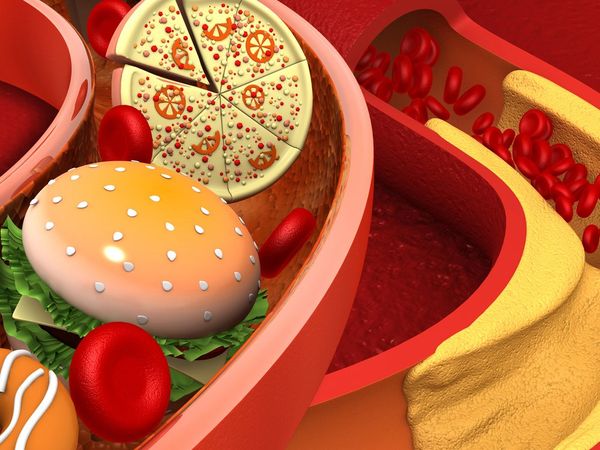 Cholesterol Artery Blockage Unhealthy Food 0 مجلة نقطة العلمية