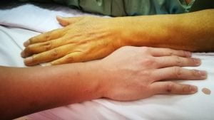Jaundice Patient Yellow Skin Hand مجلة نقطة العلمية