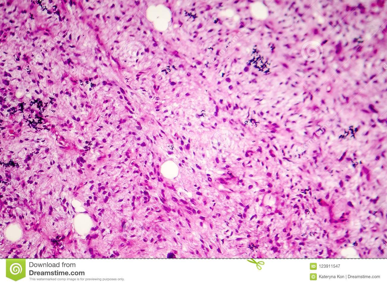 liposarcoma soft tissue sarcoma light micrograph photo under microscope liposarcoma soft tissue sarcoma 123911547 ساركوما الأنسجة الرخوة (Soft Tissue Sarcoma) مجلة نقطة العلمية